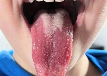 Child with scarlet fever. Photo by Dr Graham Beards. Wikimedia.