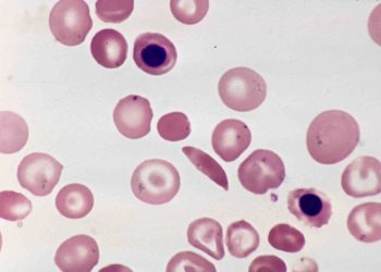 RRR sickle cell anemia. patient voice in sickle cell treatment. Photo by isis325.