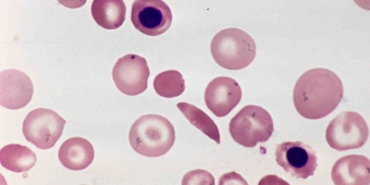 RRR sickle cell anemia. patient voice in sickle cell treatment. Photo by isis325.