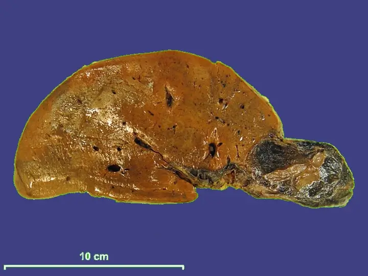 Liver hemangioma, human. Photo by Deilson Elgui de Oliveira.