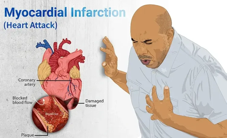 Depiction of a person suffering from a heart attack. Artwork by Myupchar.
