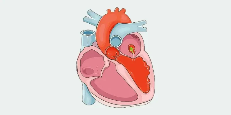 Cardiovascular system - Acute mitral regurgitation. Diagram by Laboratoires Servier.