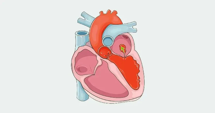 Cardiovascular system - Acute mitral regurgitation. Diagram by Laboratoires Servier.