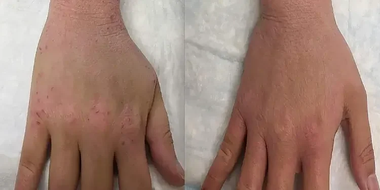 Hand and wrist of a participant in the pilot study treatment of topical steroid mitochondrial complex I-blocking drug. Photo by NIAID.