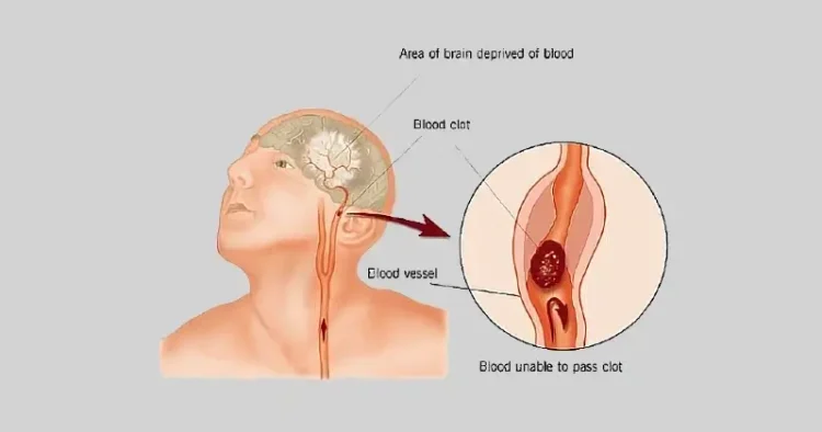 Stroke Diagram. Artwork by Construction Deal Marketing.