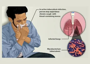 Depiction of a tuberculosis patient. Photo by Myupchar.