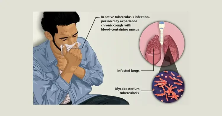 Depiction of a tuberculosis patient. Photo by Myupchar.
