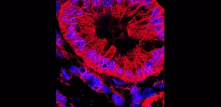 Abnormal pancreatic ducts from a mouse model of human pancreatic ductal carcinoma. David Kashatus, University of Virginia Cancer Center Photo by NIH’s National Cancer Institute.