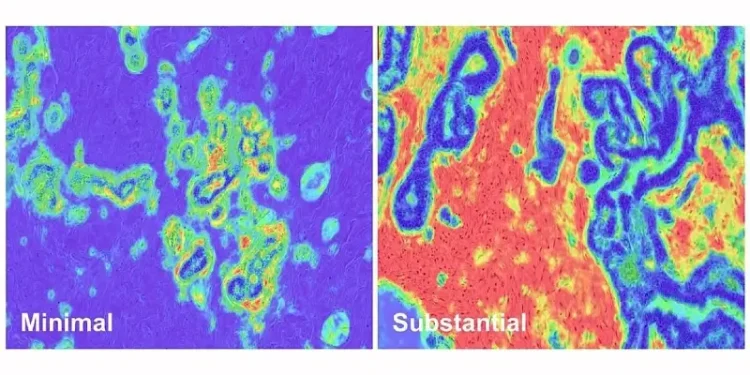 Slides showing minimal disruption and substantial disruption in breast stromal tissue. Photo by the NIH and NCI.