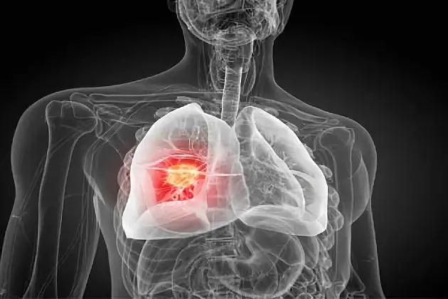 Lung Cancer. Artwork by Medicines and Healthcare products Regulatory Agency.