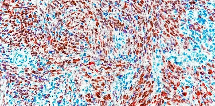 Imaging and histochemistry by Anthony B. Eason, lab of Dirk Dittmer, University of North Carolina Lineberger Comprehensive Cancer Center.
