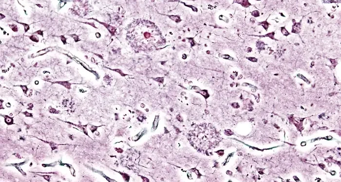 Alzheimer dementia presenile onset. Photo by KGH.